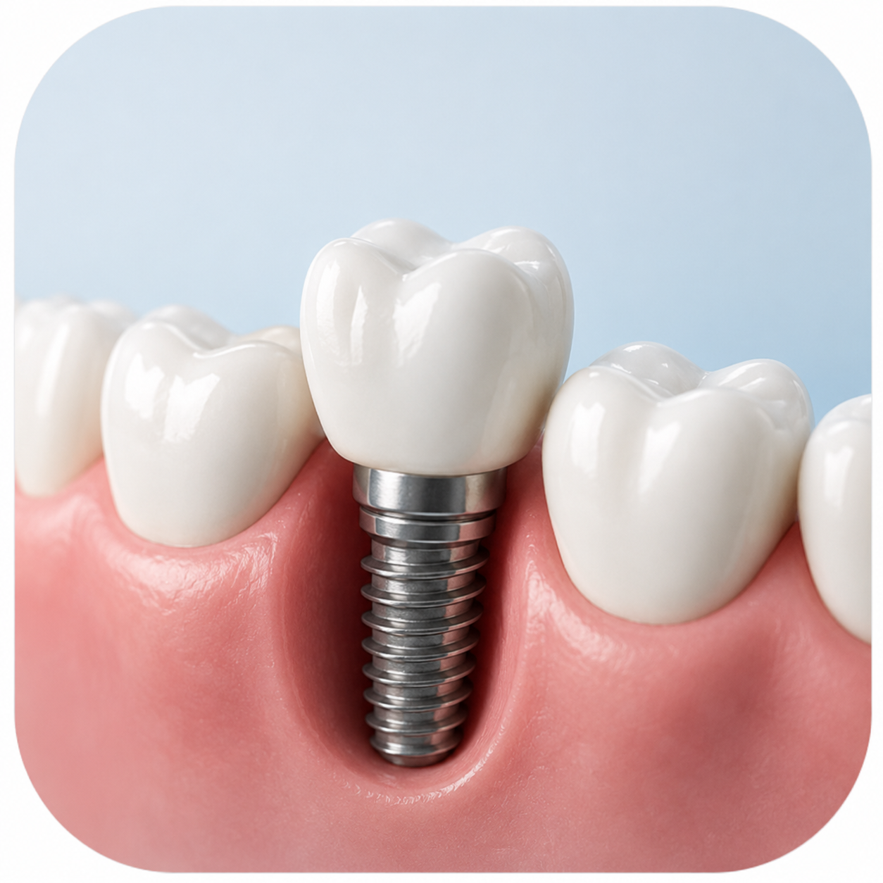Implantes Dentários